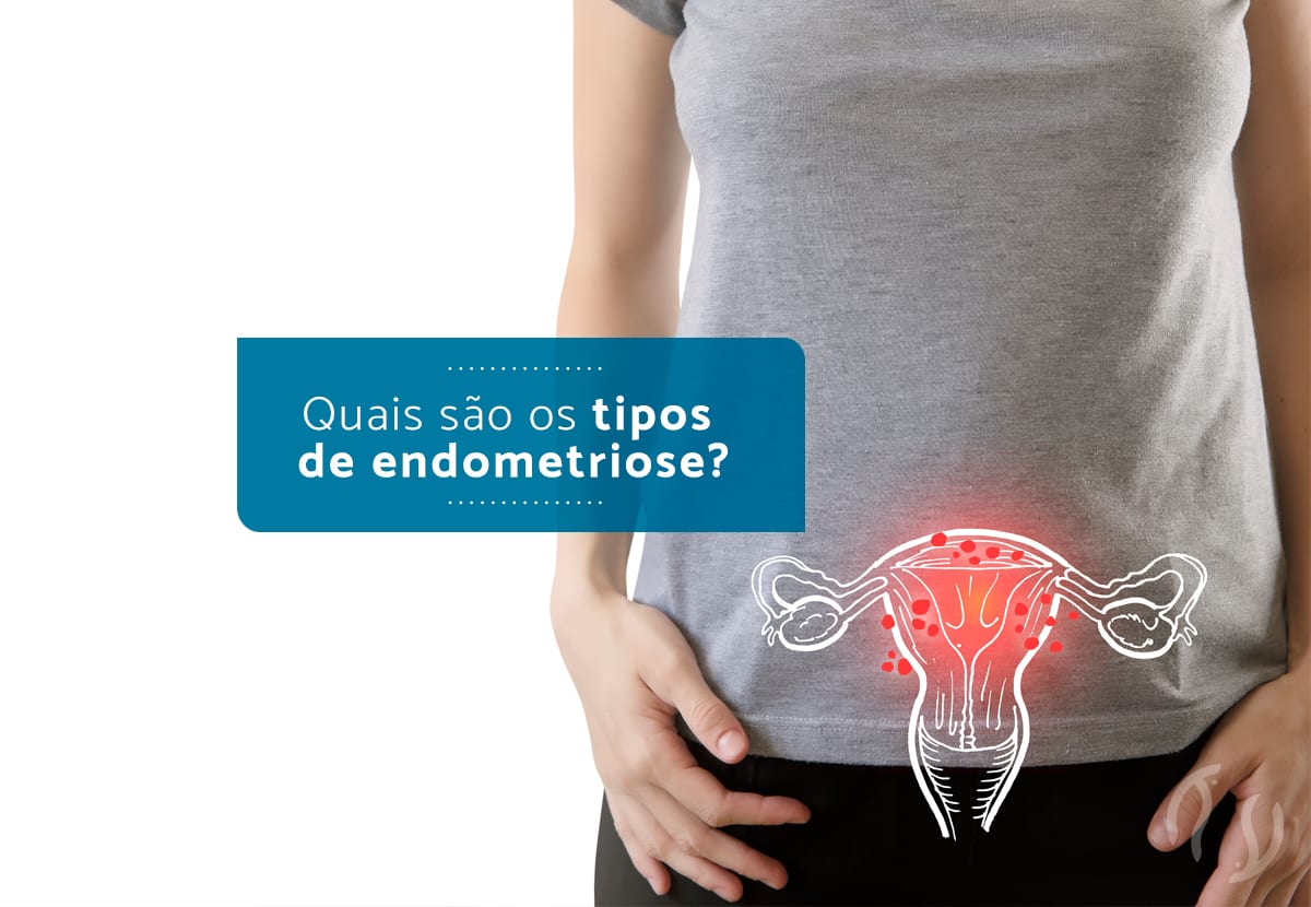 Quais S O Os Tipos De Endometriose Dr Luiz Fl Vio