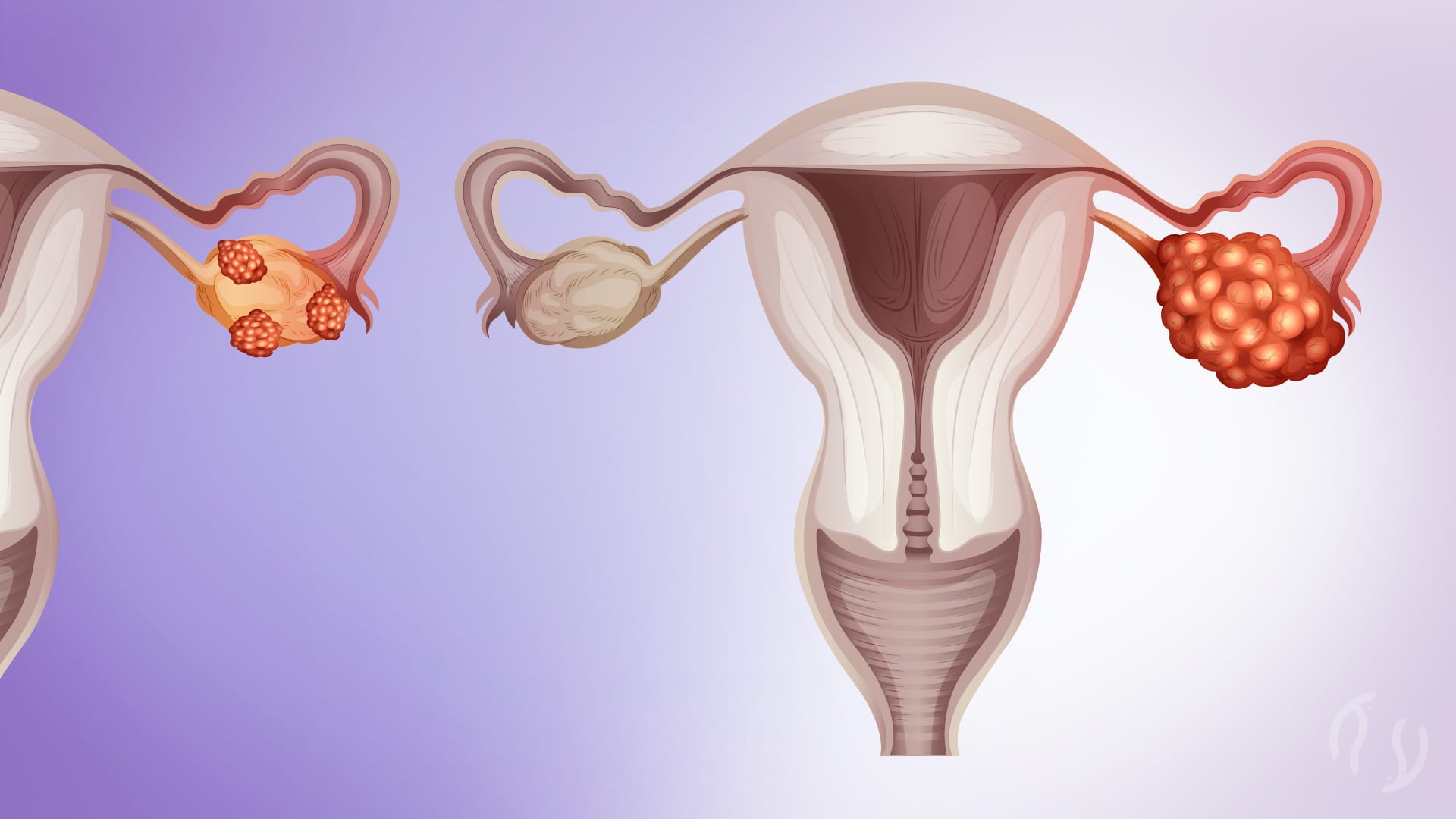 Endometriomas (Endometriose Ovariana)