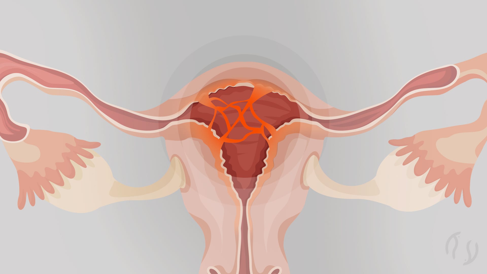 Retirada de sinéquias uterinas