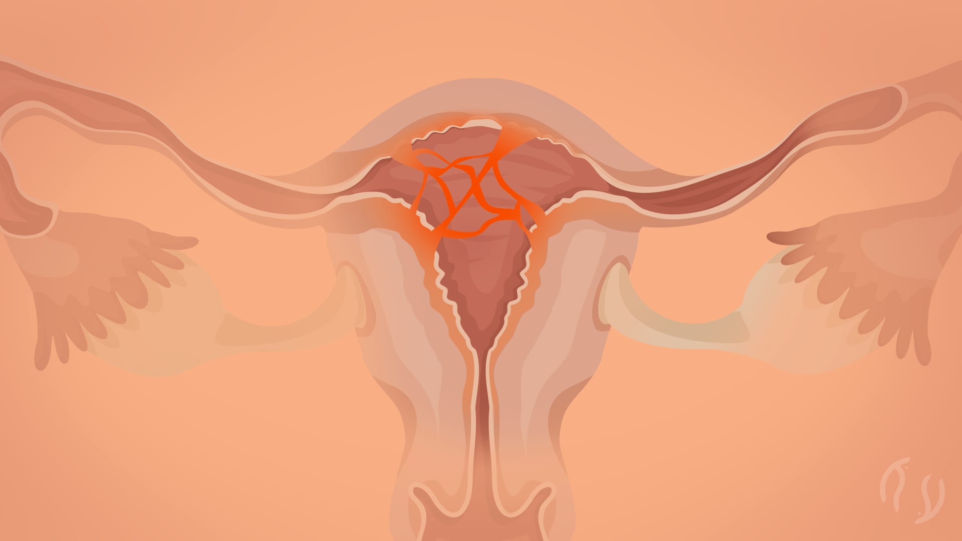 Sinéquias uterinas (Síndrome de Asherman)