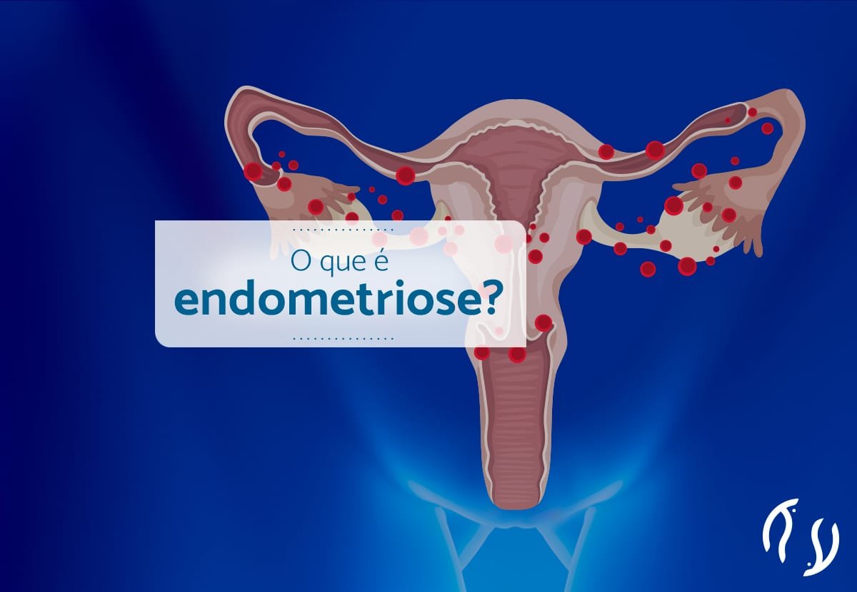 O Que é Endometriose Dr Luiz Flávio 7836