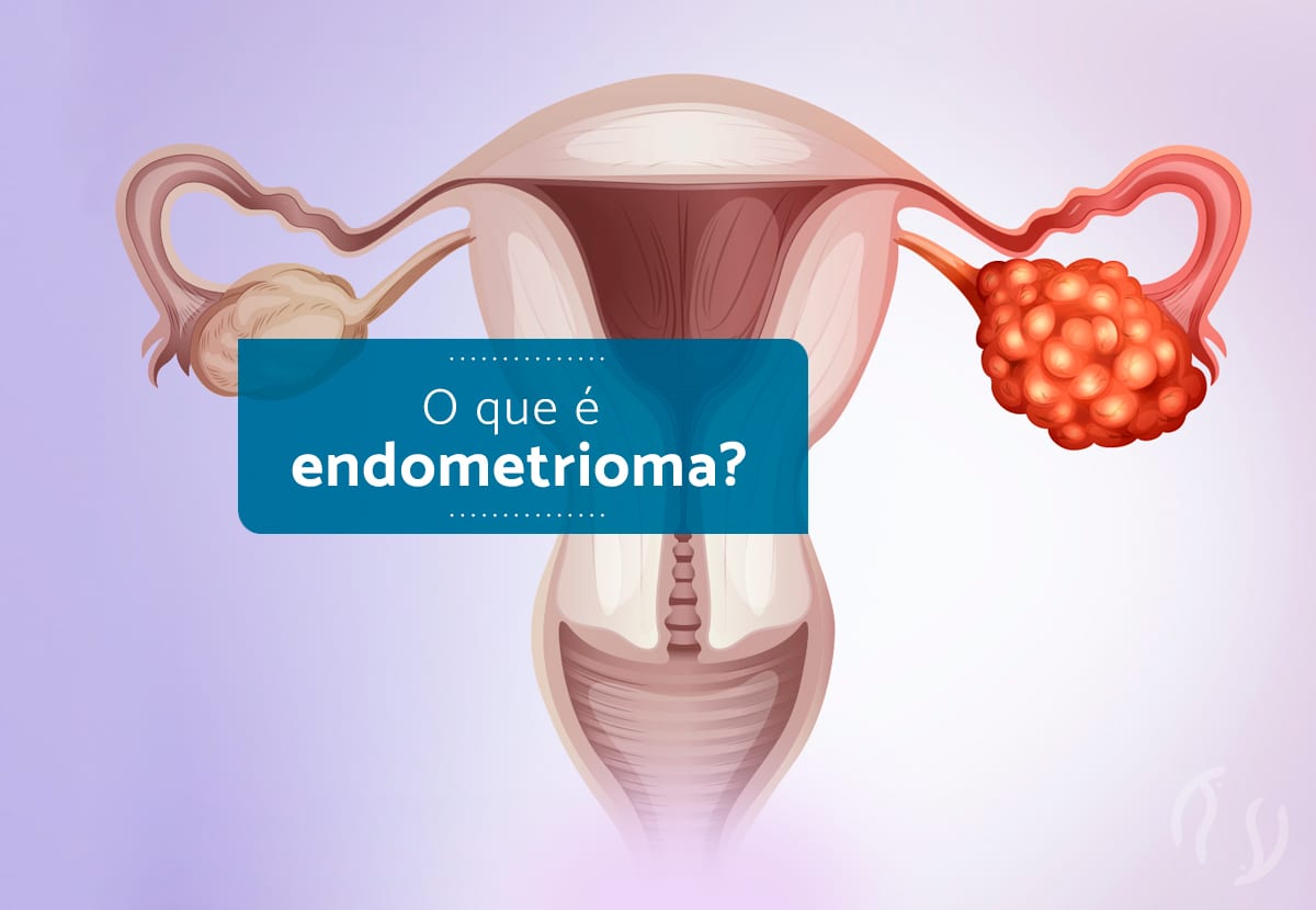 O que é endometrioma?