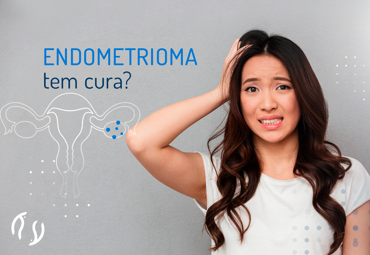 Endometrioma tem cura?