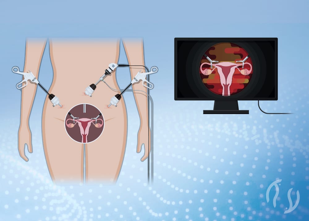 Ooforoplastia e Salpingectomia 