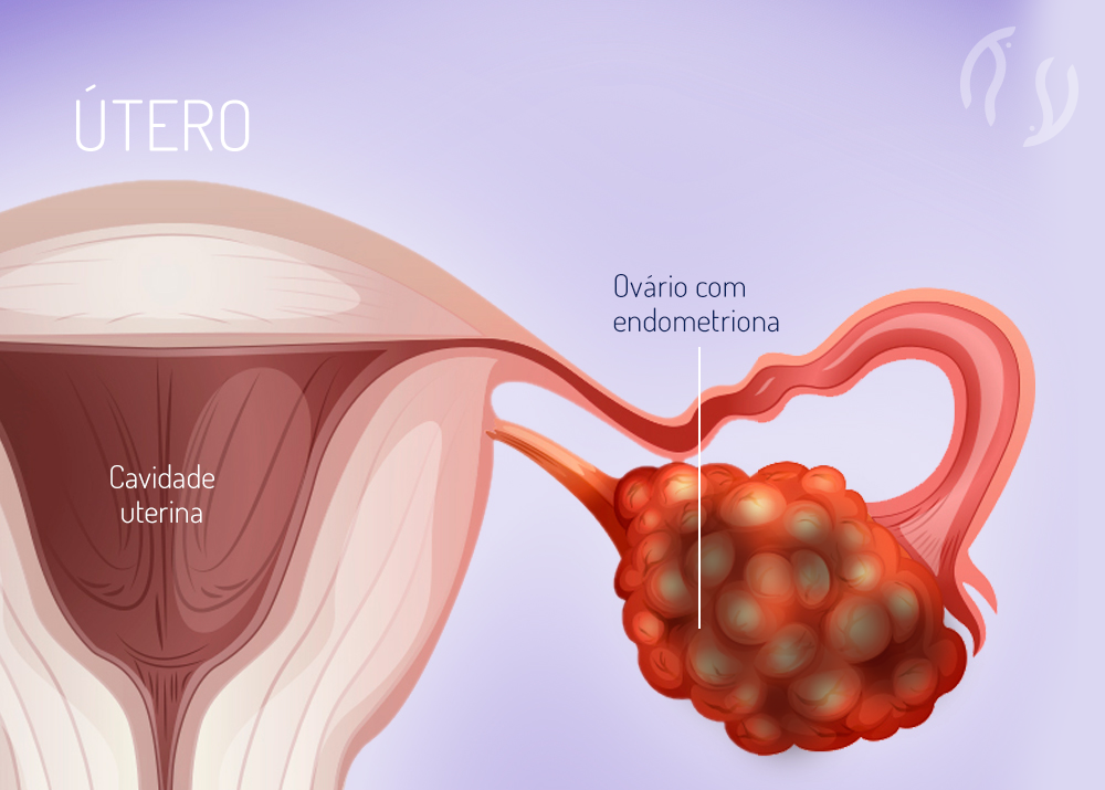 O que é endometrioma?