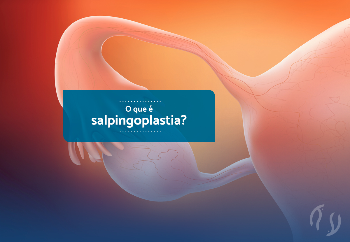 O que é salpingoplastia?