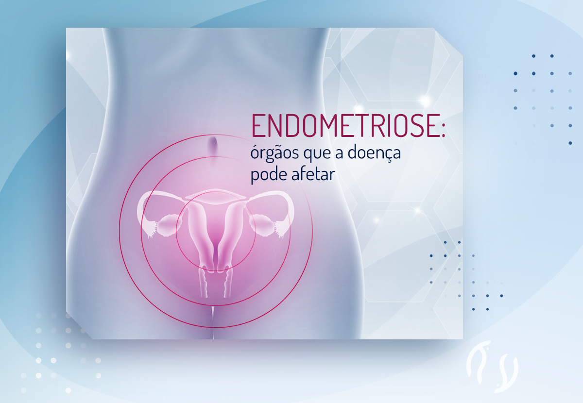 Endometriose: órgãos que a doença pode afetar