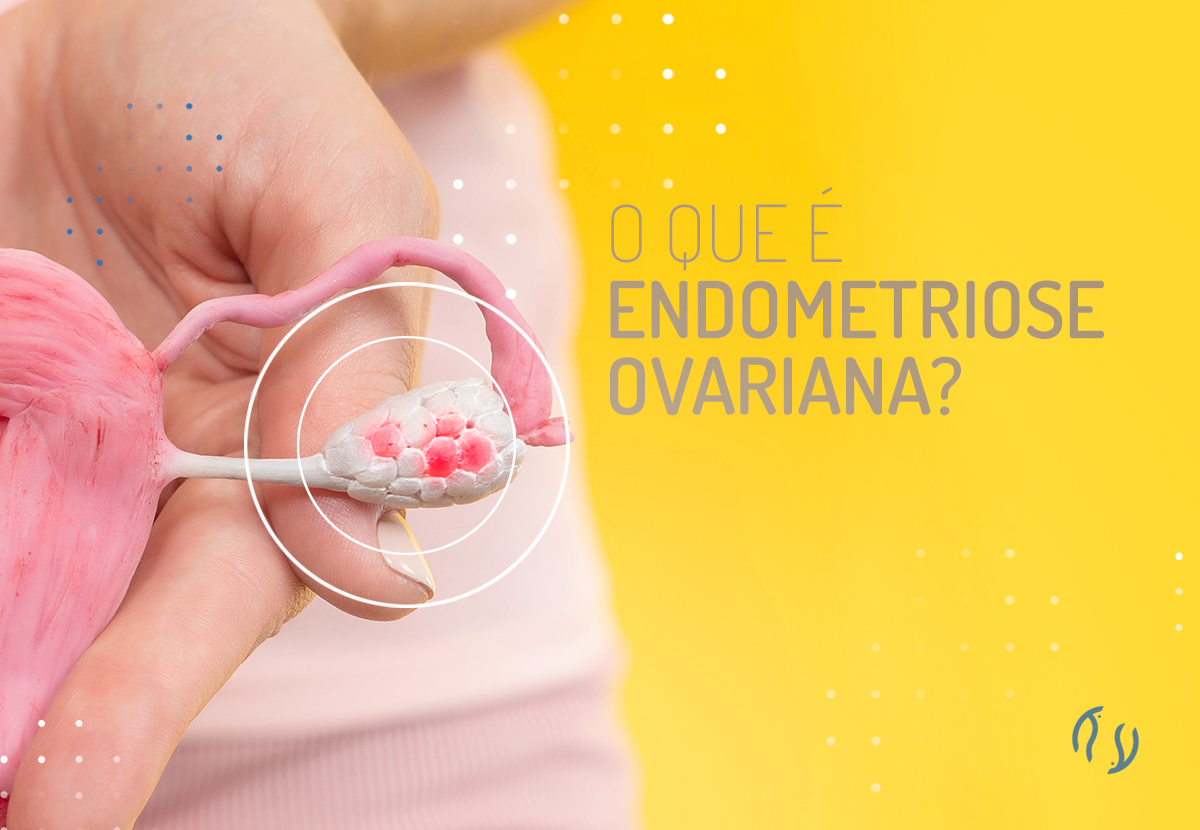 O que é endometriose ovariana?