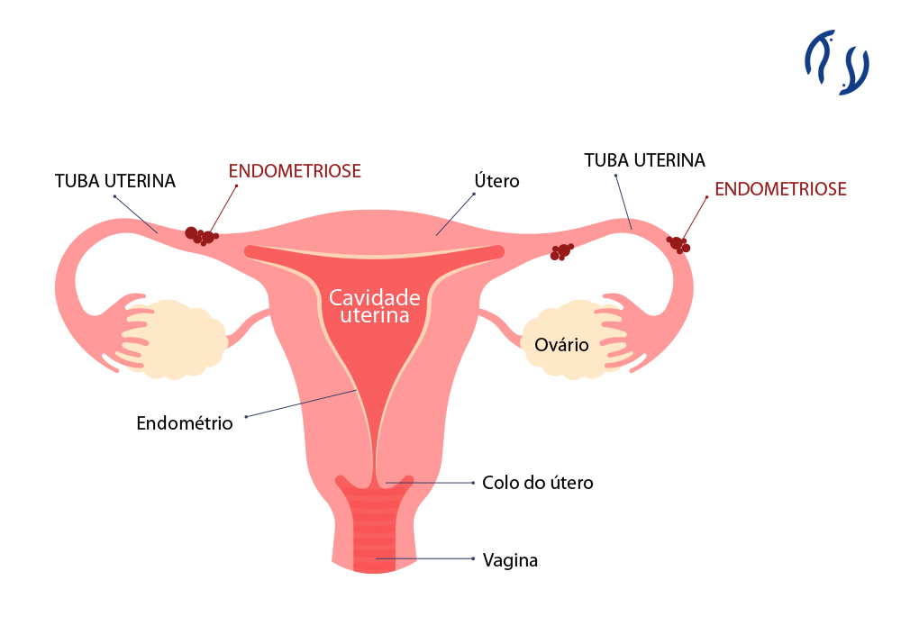 Endometriose Nas Tubas Uterinas Sintomas Dr Luiz Flávio 1886