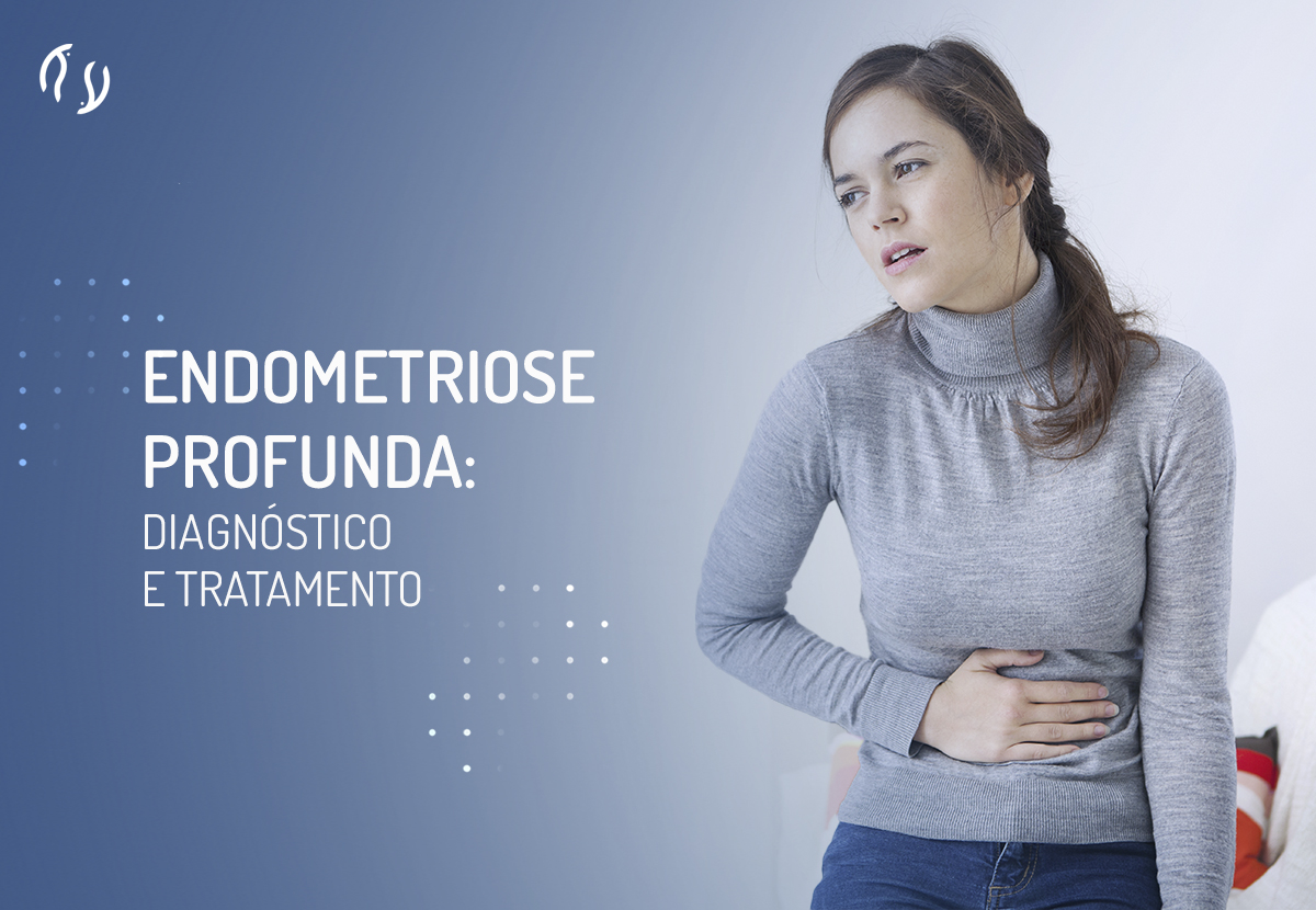 Endometriose profunda: diagnóstico e tratamento